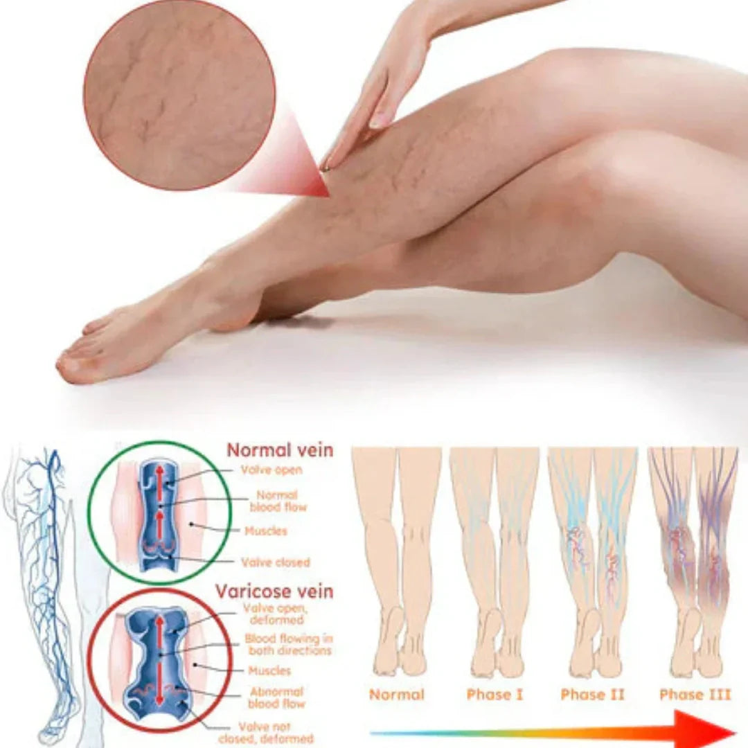 Varicose Veins Treatment Spray(Buy 1 Get 1 Free)