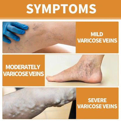 Varicose Veins Treatment Spray(Buy 1 Get 1 Free)